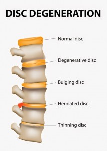 Examples-of-disc-injury